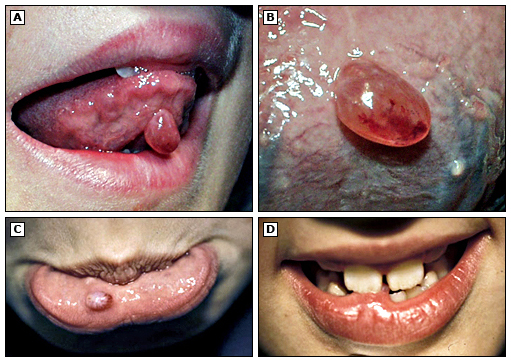Tratamiento de Mucocele Medident Center
